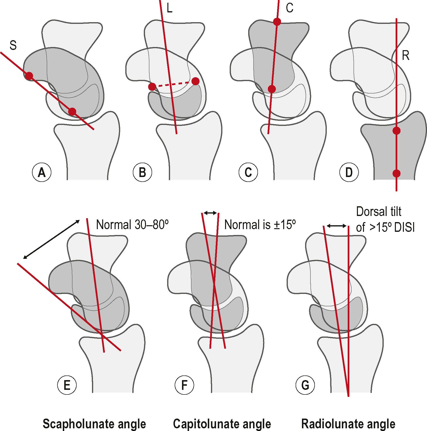 Figure 3.23, Carpal indices. Axes are drawn based on the true lateral wrist radiograph. (A) The scaphoid (S) is represented by a tangential line that connects the two palmar convexities of the bone. (B) The lunate (L) axis is perpendicular to a line that joins the two distal horns of the bone. (C) The capitate (C) axis is determined by the center of the two proximal and distal articular surfaces. (D) The axis of the radius (R) is obtained by tracing perpendicular lines to its distal third and connecting the center of these lines. (E) Normal scapholunate angles. (F) Normal capitolunate angles. (G) Normal radiolunate angles. DISI, dorsal intercalated segmental instability.