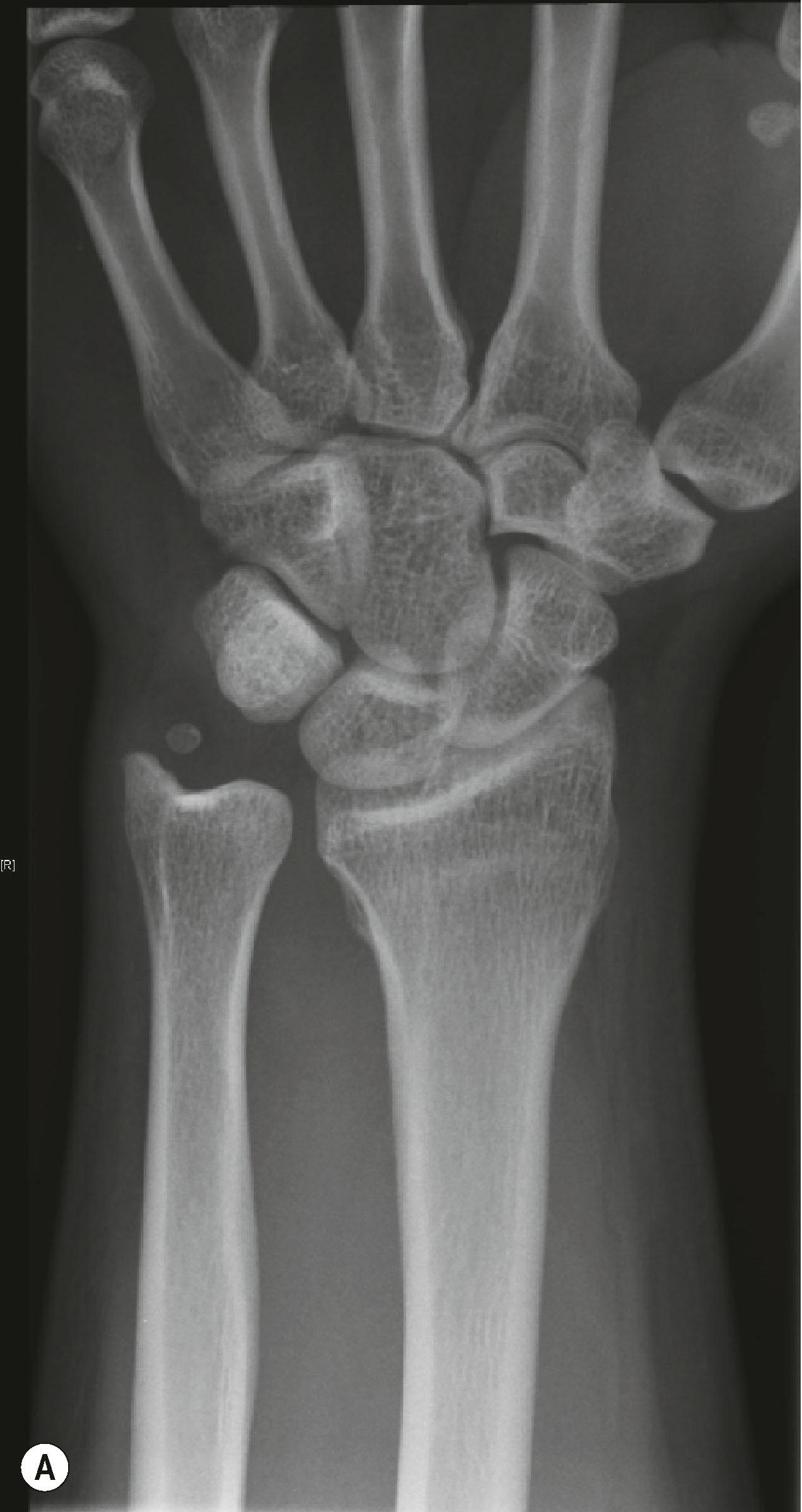 Figure 3.25, This patient presented with signs and symptoms of ulnar carpal abutment. The positive ulnar variance (A) is increased with the pronated clenched-fist view (B) .