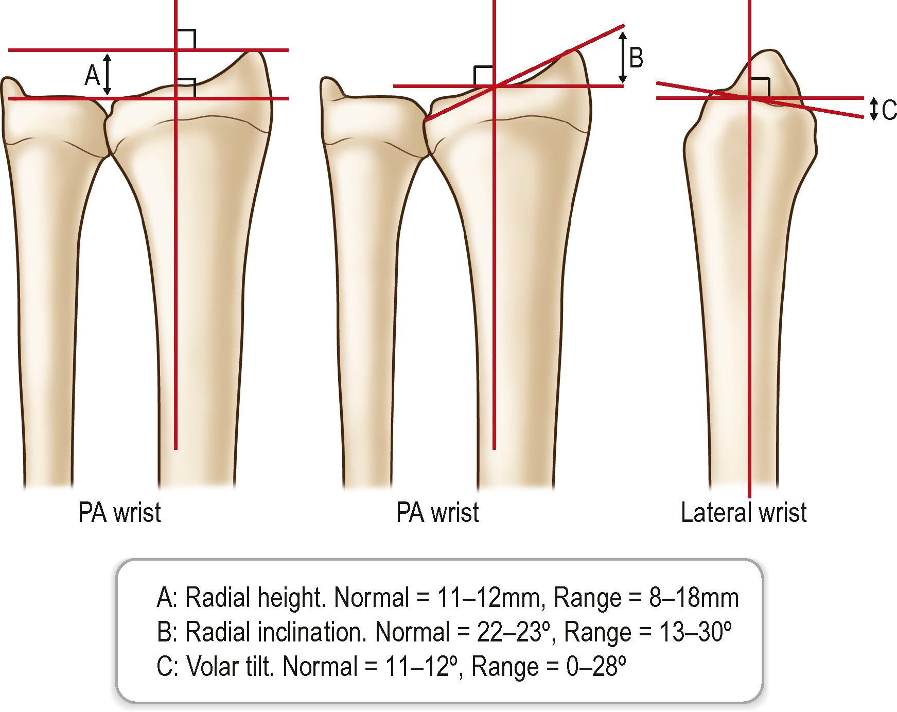 Figure 3.26, Normal distal radius indices. PA, Posteroanterior.