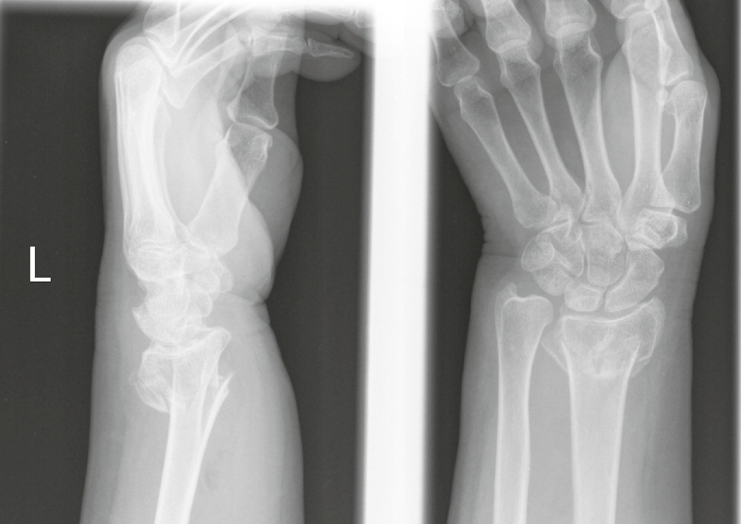 Figure 3.27, Distal radius fracture with loss of the normal radial height, inclination, and volar tilt.