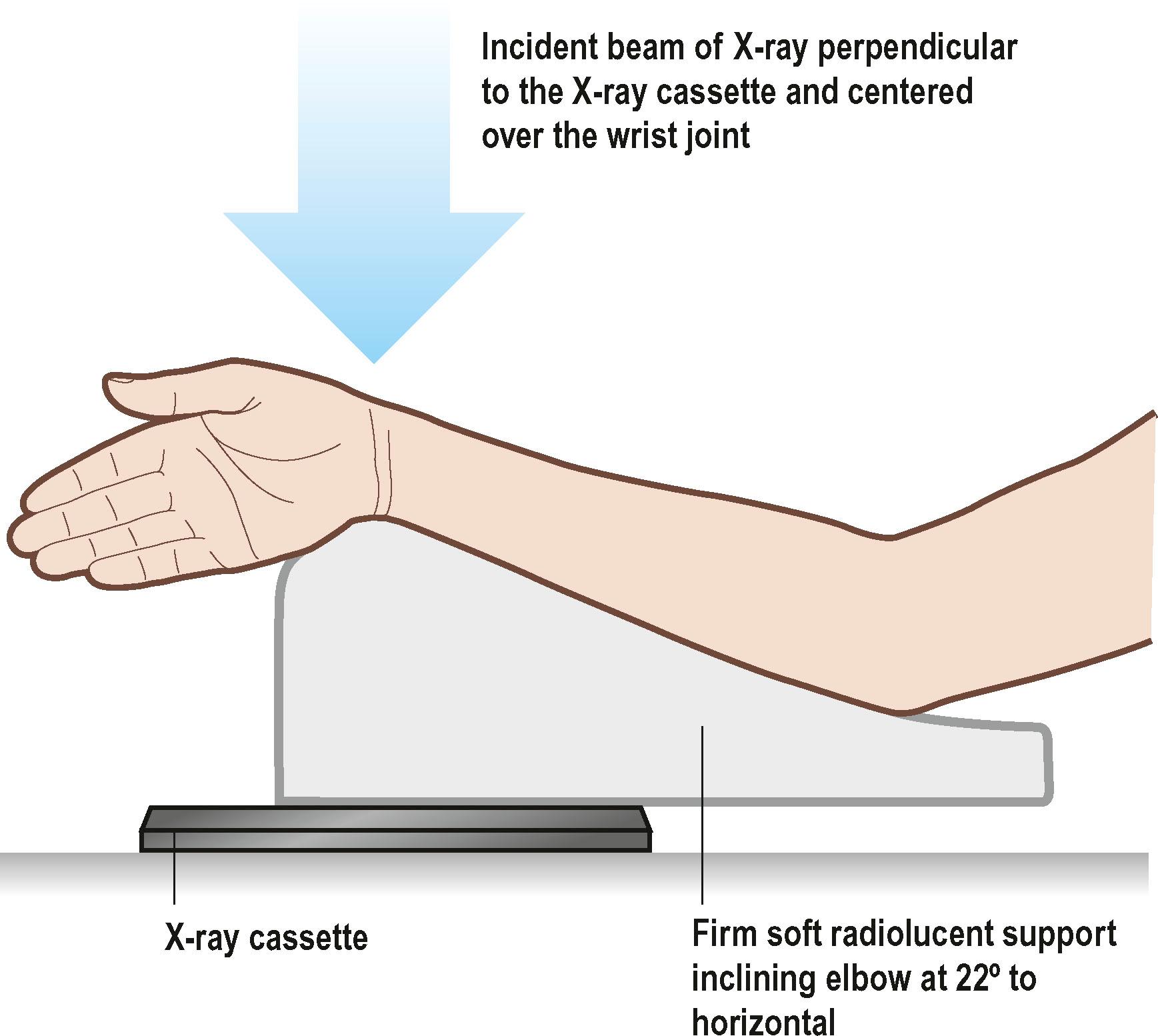 Figure 3.28, Position of the limb and direction of X-ray beam for an anatomical tilt lateral view of the distal radius. This view is very helpful for assessing screw position when applying plates and screws close to the articular surface in distal radius fractures.