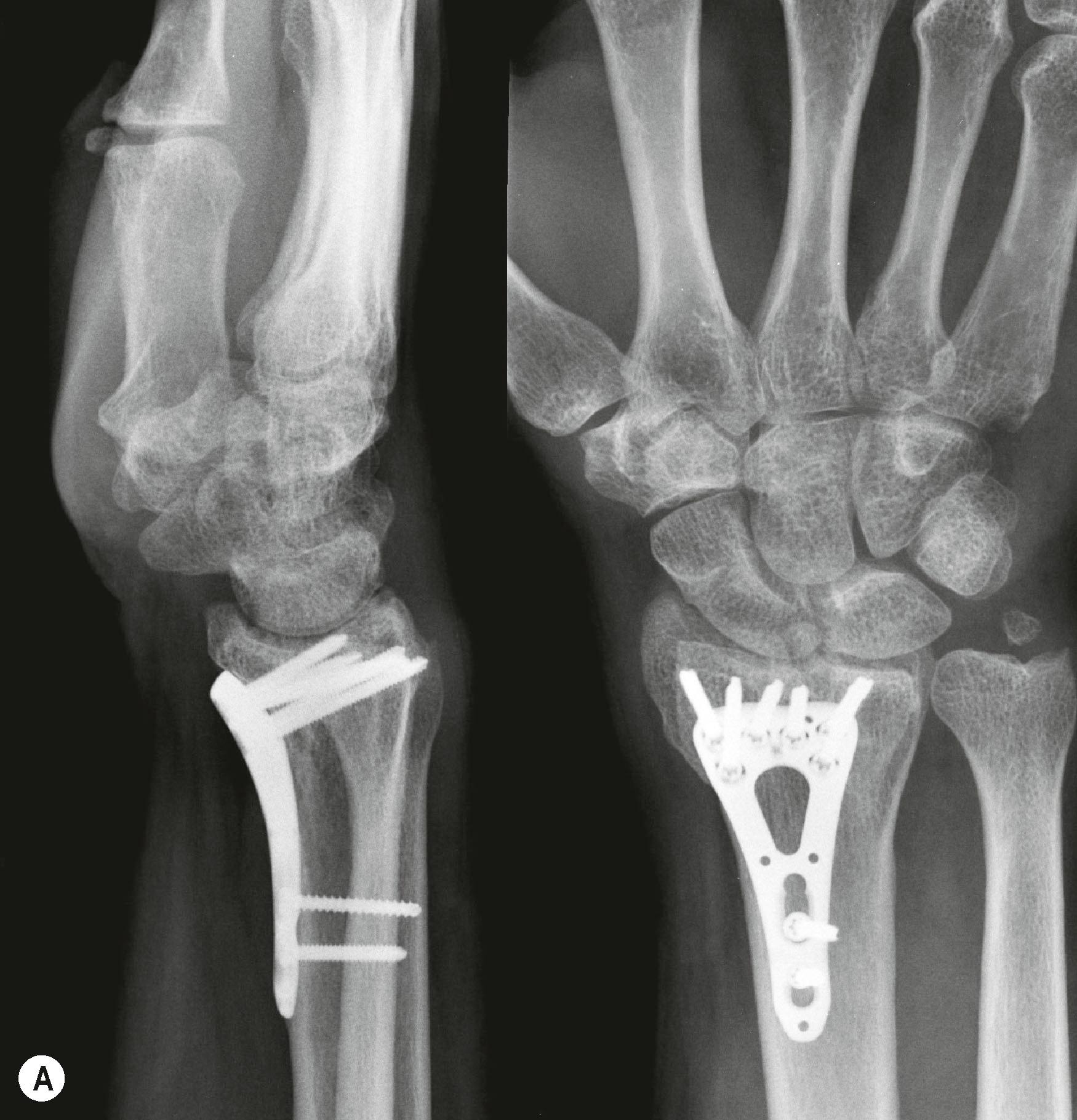 Figure 3.29, (A) Standard PA and lateral wrist X-rays showing a distal radius fracture post-fixation. (B) Supination and pronation views showing dorsal screw penetration. (C) Dorsal horizon view showing dorsal screw penetration.