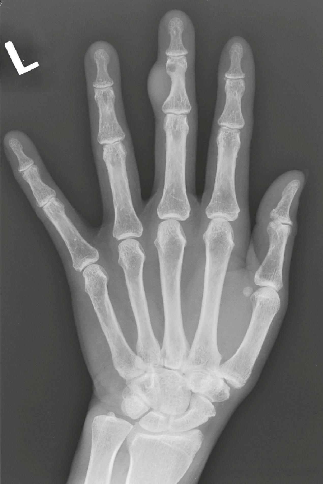 Figure 3.3, This female patient presented with a soft-tissue mass over the ulnar side of the middle finger. The radiograph shows the outline of the soft-tissue mass with scalloping of the ulnar border of the middle phalanx. Histology of the mass showed this to be a pigmented villonodular synovitis.