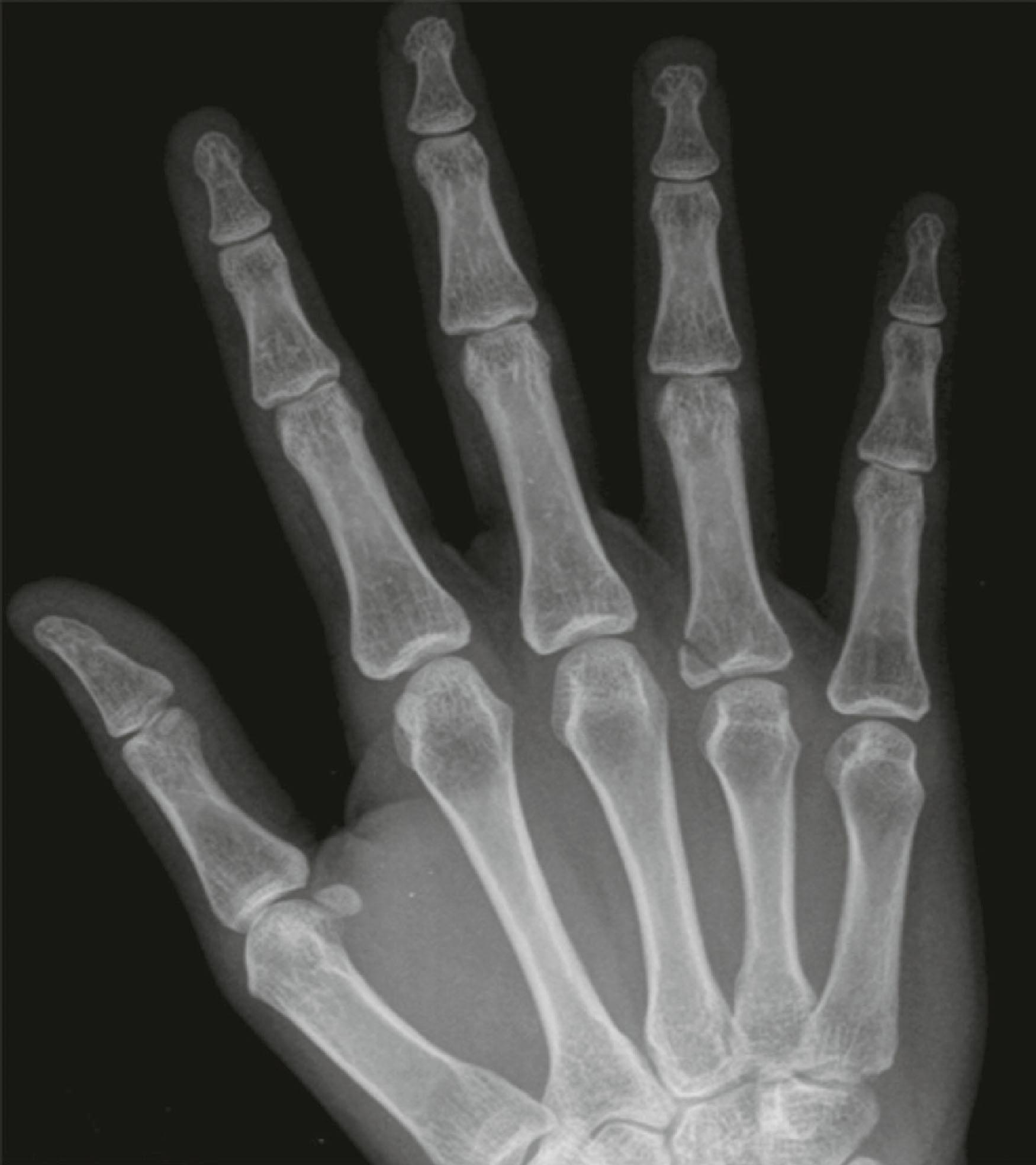 Figure 3.4, This nurse presented with pain at the base of her right ring finger after transferring a patient from his bed to a chair. The radiograph shows a partial articular fracture of the base of the proximal phalanx of the right ring finger. The area of lucency just at the fracture site and minor trauma were suspicious for a pathological fracture.