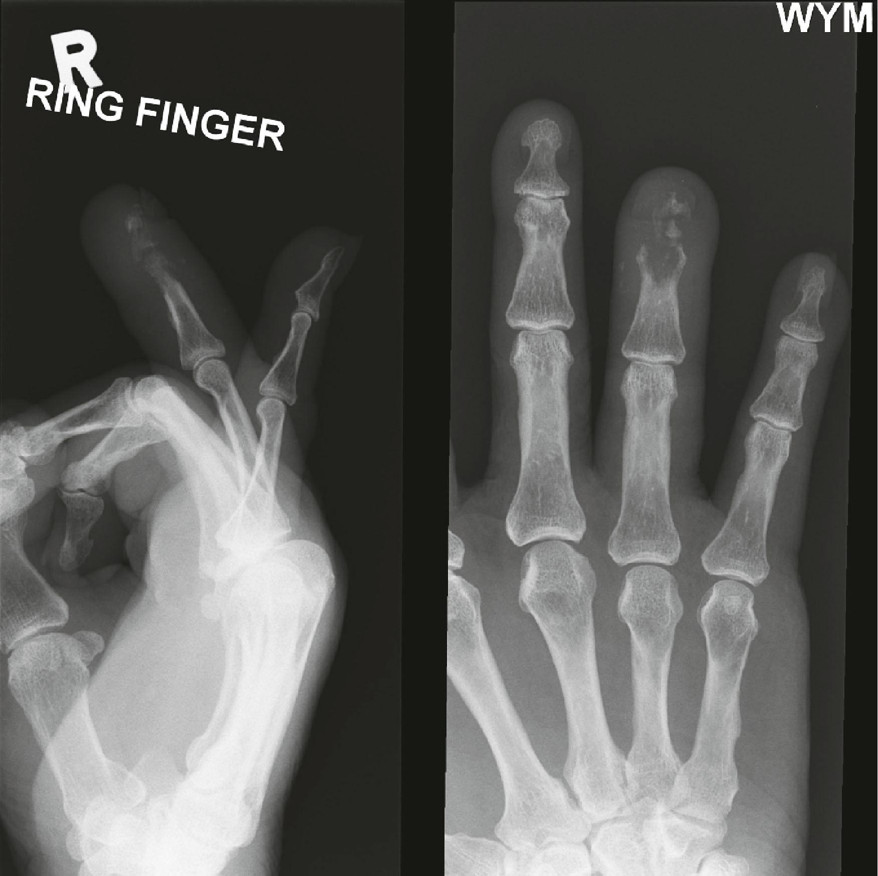 Figure 3.5, This elderly man presented with increasing pain and redness in the finger. The radiograph shows a destructive lesion of the distal phalanx and head of the middle phalanx. This is consistent with osteomyelitis. A differential diagnosis would be that of a malignant bone tumor. These are much rarer, and usually due to metastatic disease in terminally ill patients.