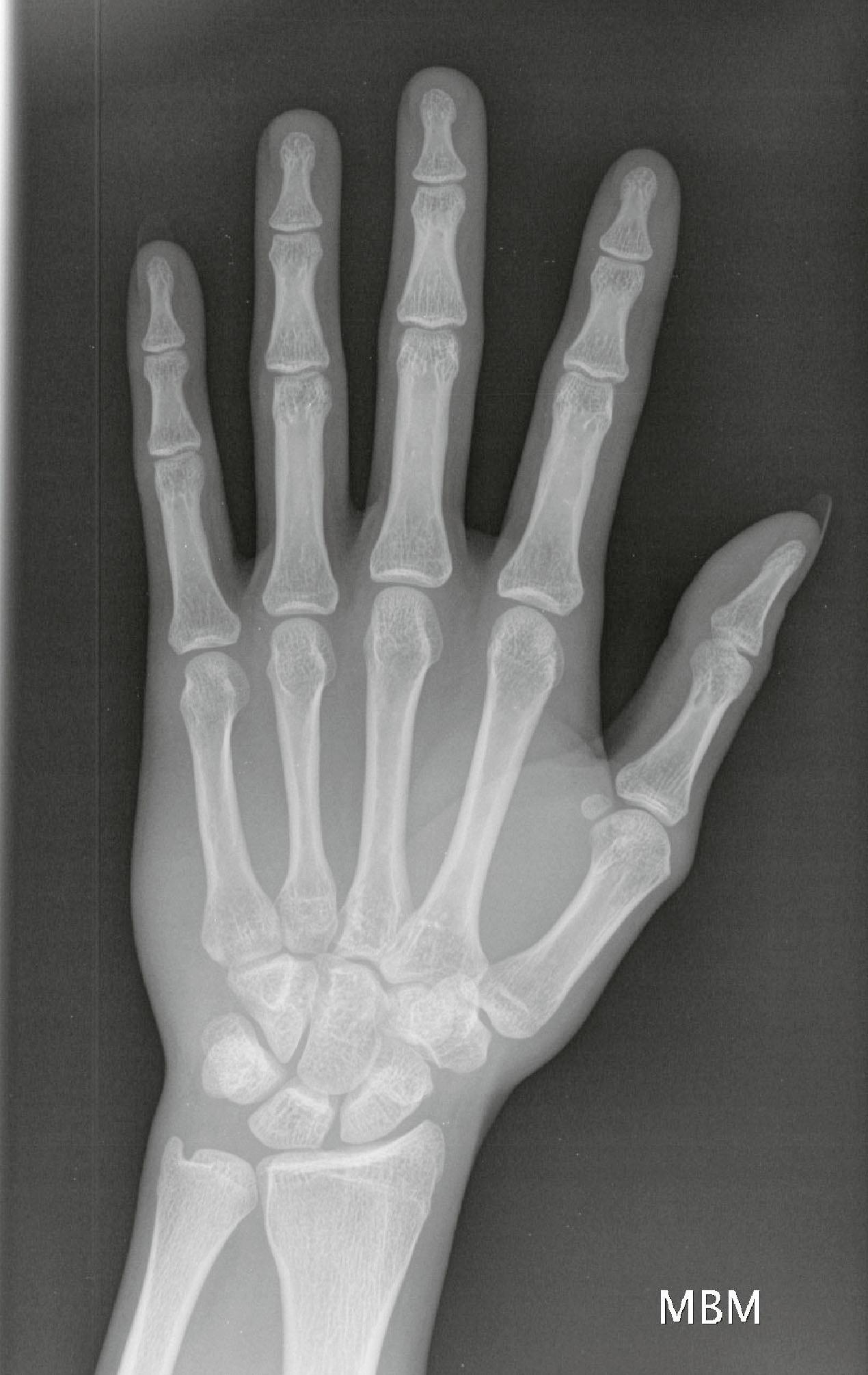 Figure 3.6, In a normal hand radiograph, the second to fifth carpometacarpal joints should be well visualized, as shown. The articular surfaces should be profiled without overlap, parallel to each other, and have distinct cortical rims.