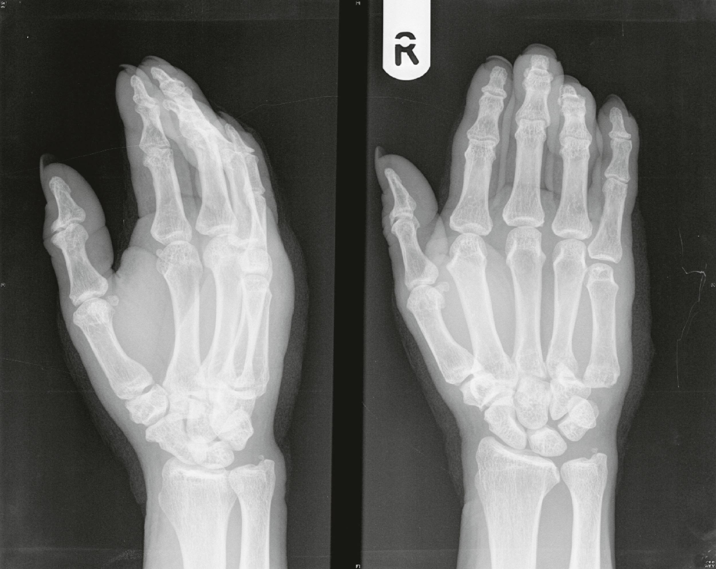 Figure 3.7, This radiograph shows a dislocation of the fifth carpometacarpal joint. Note the ulnar offset of the fifth metacarpal with loss of the normal articular space.