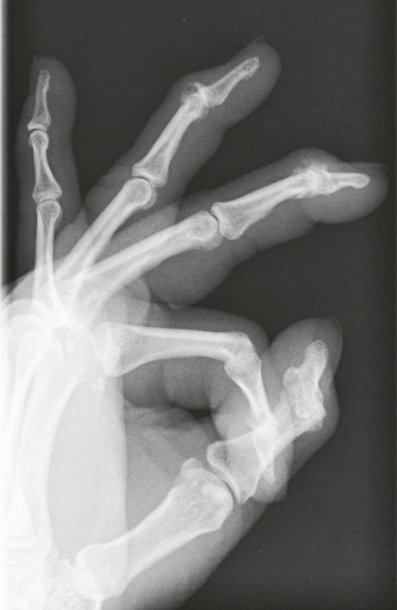 Figure 3.8, Osteoarthritis of the distal interphalangeal joints of middle and ring fingers. There is loss of joint space, and osteophytes are clearly seen on this lateral view.