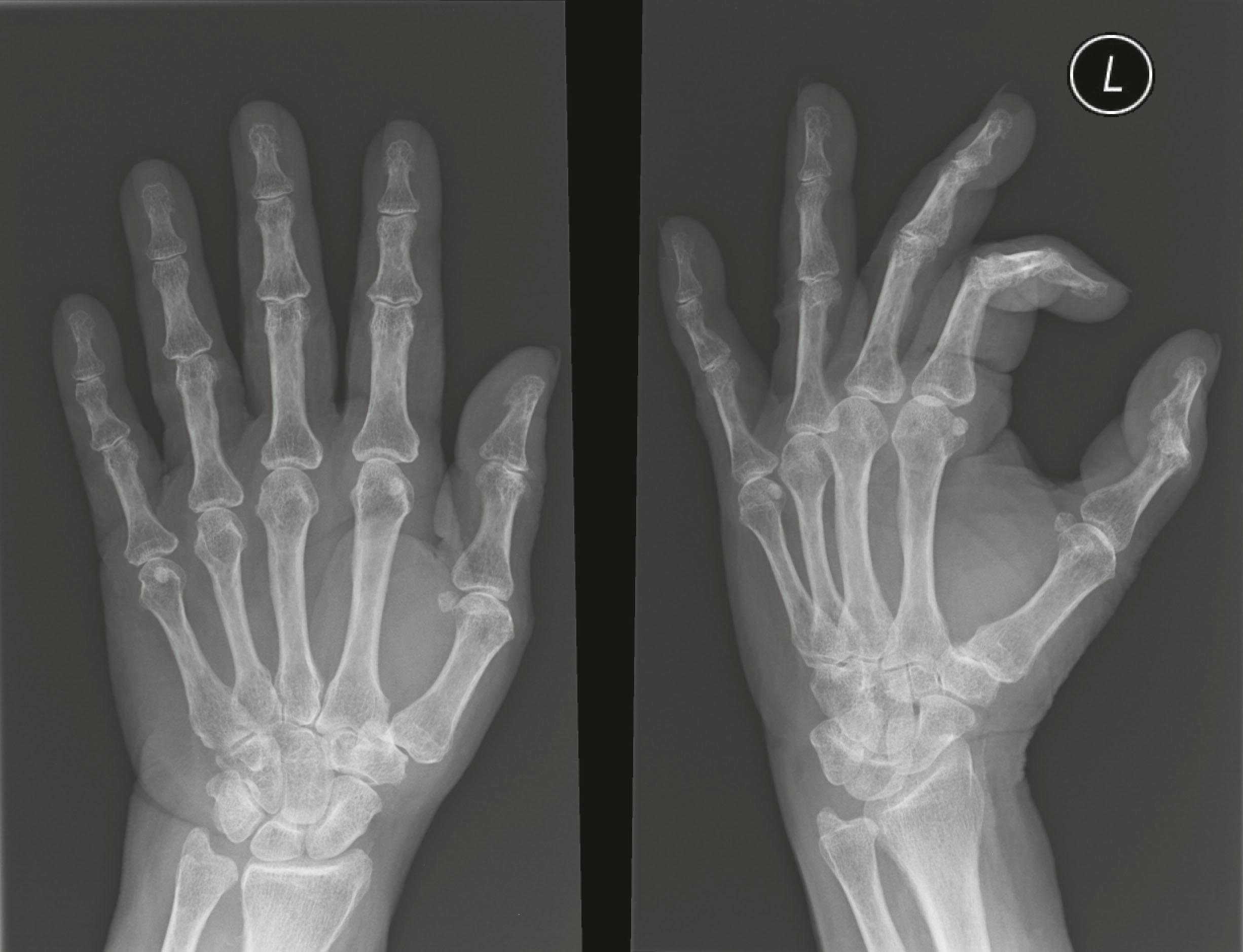 Figure 3.9, The trapeziometacarpal joint shows narrowing of the joint space with osteophytes and joint subluxation.