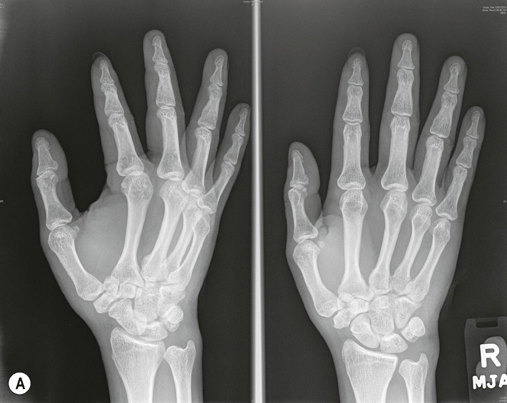 Figure 3.10, (A) Hand radiograph showing a trapezium fracture. (B) The Bett's view demonstrates the trapezial fracture and the step in the articular surface clearly.