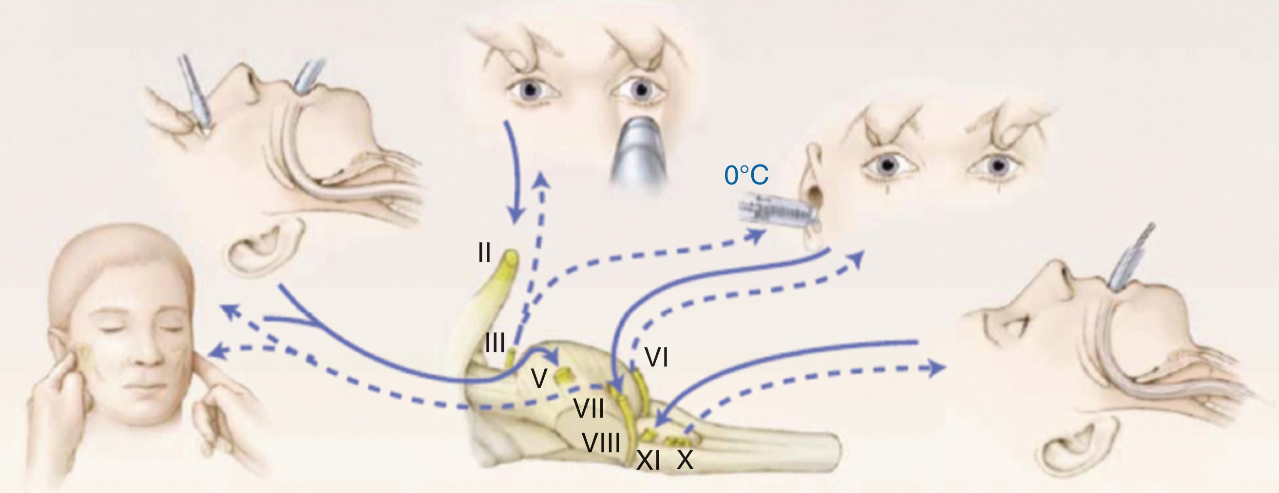FIGURE 2, The steps in a clinical examination to assess brain stem reflexes. The tested cranial nerves are indicated by Roman numerals, the solid arrows represent afferent limbs, and the broken arrows, efferent limbs. Depicted are the absence of grimacing or eye opening with deep pressure on both condyles at the level of the temporomandibular joint (afferent nerve V and efferent nerve VII), the absent corneal reflex elicited by touching the edge of the cornea (V and VII), the absent light reflex (II and III), the absent oculovestibular response toward the side of the cold stimulus provided by ice water (pen marks at the level of the pupils can be used as reference) (VIII and III and VI), and the absent cough reflex elicited through the introduction of a suction catheter deep in the trachea (IX and X).