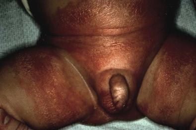 Figure 17.1, Irritant diaper dermatitis with characteristic sparing of the folds.