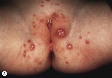 Figure 17.2, (A) Jaquet's dermatitis. Well-demarcated, punched-out erosions, and ulcers primarily on convex surfaces.