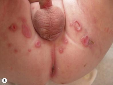 Figure 17.2, (B) Jacquet's dermatitis. Well-demarcated erosions, primarily on convex surfaces.