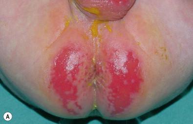 Figure 17.3, (A) Erosive perianal eruption in an infant with chronic diarrhea.