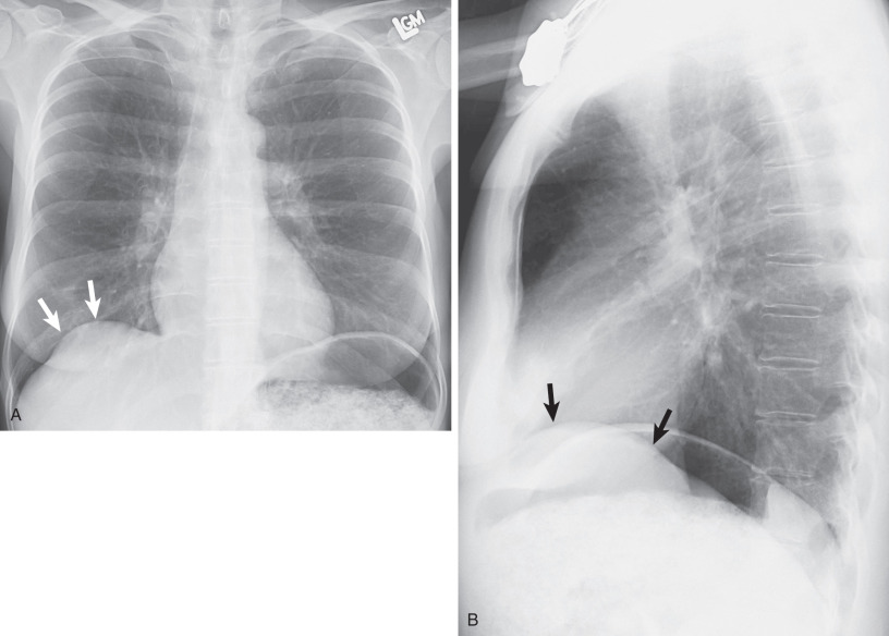 Fig. 78.2, Small eventration of the right hemidiaphragm. Posteroanterior (A) and lateral (B) chest radiographs show focal elevation (arrows) of the anteromedial portion of the right hemidiaphragm, typical of eventration. The right hemidiaphragm is not elevated posteriorly, unlike with paralysis.