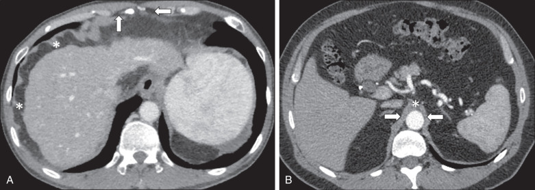 Figure 33.1, Normal appearance of the diaphragm on CT. (A) Diaphragmatic slips (asterisks) attach to the ribs and sternum. Note the fat- and vessel-containing sternocostal triangles (arrows), anterior to the diaphragm, between the sternum and ribs. (B) Left and right crura of the diaphragm (arrows) arch anterior to the aorta to join at the median arcuate ligament (asterisk) .