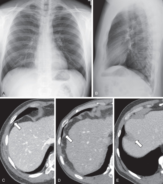 Figure 33.2, Normal appearances of diaphragm. Frontal (A) and lateral (B) radiographs. The diaphragm appears as a smooth, dome-shaped structure with symmetric height on both sides. On CT, diaphragm can be smooth (C) or nodular in contour (D), depending on the phase of respiration (arrows) . (E) Prominent diaphragmatic folds may simulate masses in the adjacent liver or spleen.