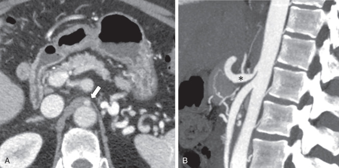 Figure 33.3, Median arcuate ligament syndrome. Axial (A) and sagittal (B) CT scans demonstrate a narrowed celiac artery at the commissure of the left and right crura of the diaphragm, the median arcuate ligament (arrow), with poststenotic dilation of a J -shaped celiac artery (asterisk) .