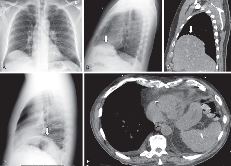 Figure 33.4, Elevated diaphragm. (A) Frontal radiograph demonstrates elevation of the right hemidiaphragm relative to the left, but it is nonspecific for cause. Lateral radiograph (B) and sagittal CT scan (C) demonstrate a humplike elevation of the anterior portion of the right hemidiaphragm (arrows), consistent with eventration. (D) Lateral radiograph in a different patient demonstrates elevation of the entire left hemidiaphragm (arrow), in this case secondary to paralysis. (E) Axial CT scan through the lower chest demonstrates asymmetric presence of abdominal viscera on the left, which should alert the radiologist to diaphragmatic elevation, in this case due to paralysis.