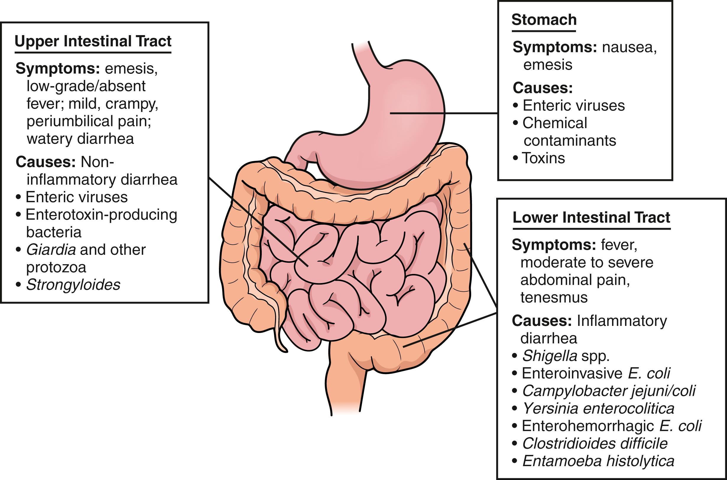 Fig. 14.1, Localizing gastrointestinal tract signs and symptoms and possible causes of illness.