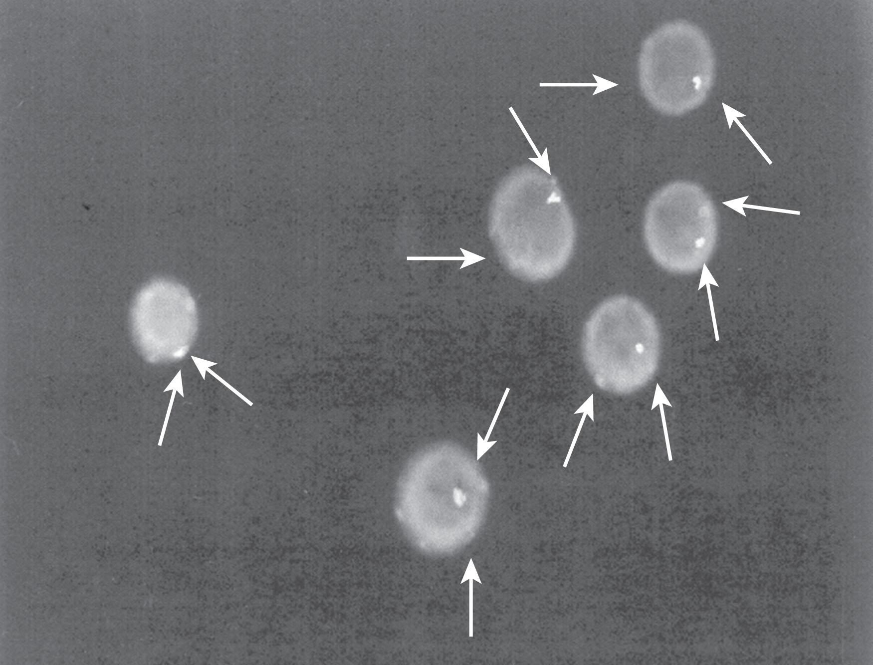Fig. 85.12, Fluorescence in situ hybridization technique demonstrating the sex chromosome constitution of peripheral blood leukocytes. Arrows point to sex chromosomes in each cell.