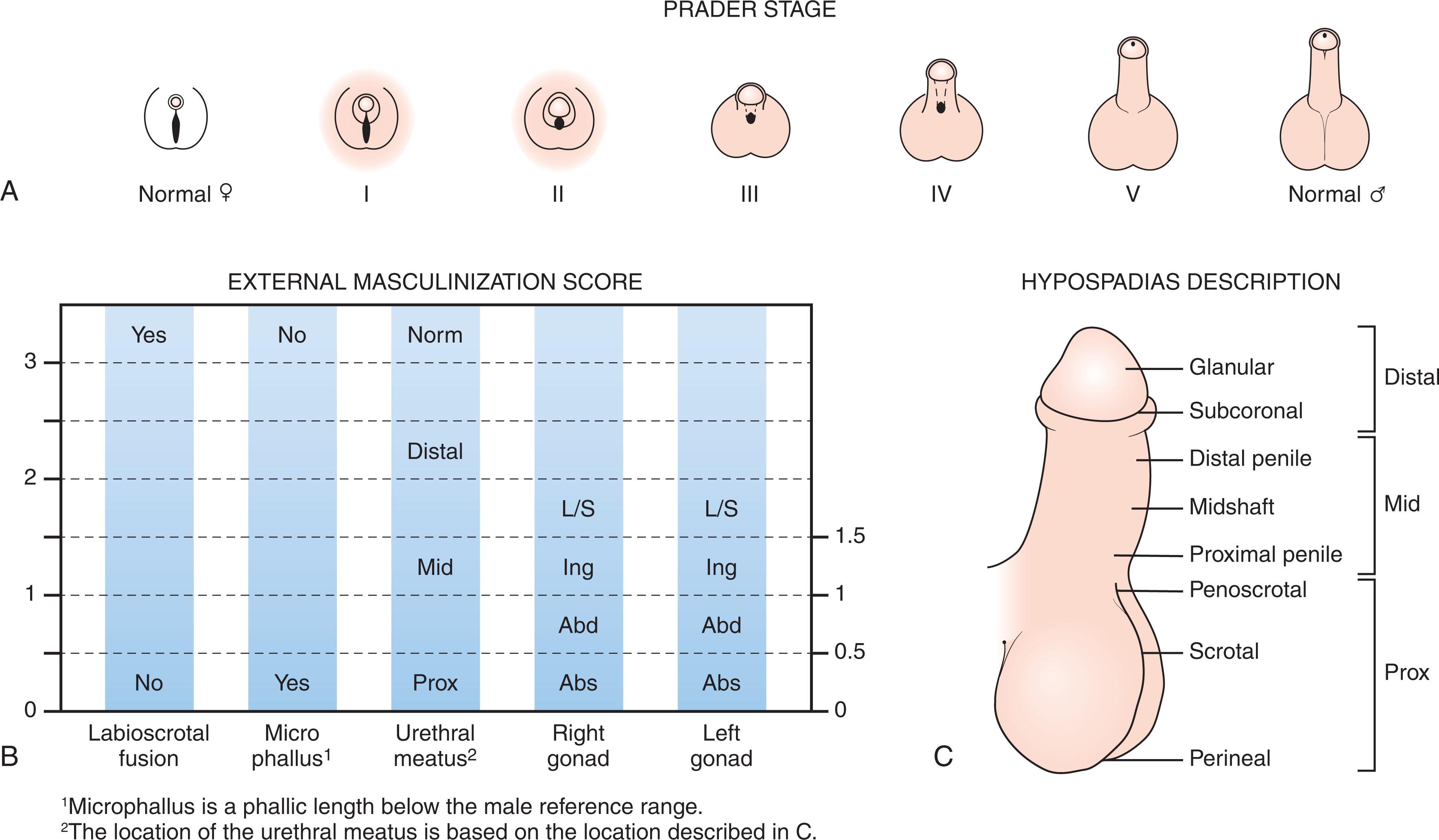 Fig. 85.3, (A) The stages of virilization of the female with congenital adrenal hyperplasia as developed by Prader. Stage I indicates mild clitoromegaly only; stage V indicates complete masculinization. (B) External masculinization score. A score of 0 to 3 is given for four aspects of male external genitalia. The sum of the four values is the external masculinization score. A normal male has a value of 12. (C) Hypospadias description. Abd , Abdomen; Abs , absent; Ing , inguinal; L/S , labioscrotal; norm , normal; prox , proximal.