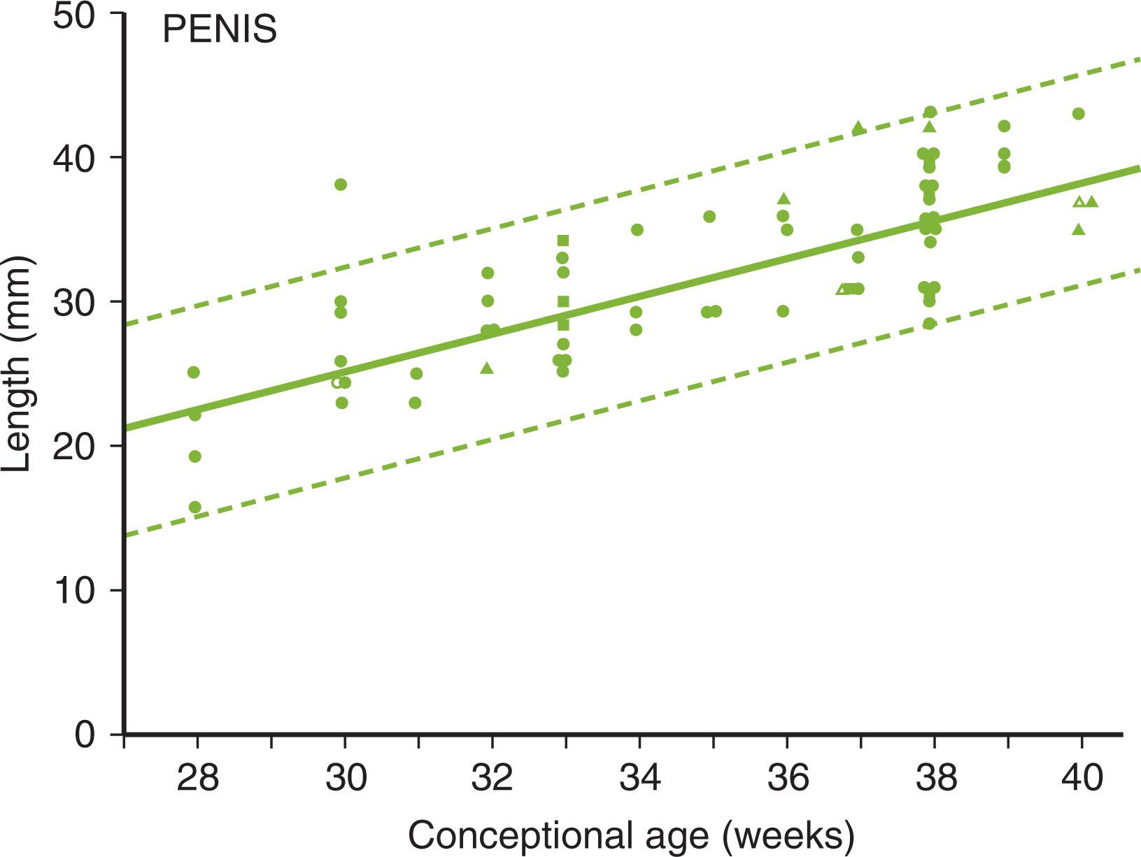 Fig. 85.4, Penis stretch length in 63 normal premature and full-term male infants (circles) , showing lines of mean ± two standard deviations. Superimposed are data for two small-for-gestational-age infants (open triangles) , seven large-for-gestational-age infants (closed triangles) , and twins (squares) .