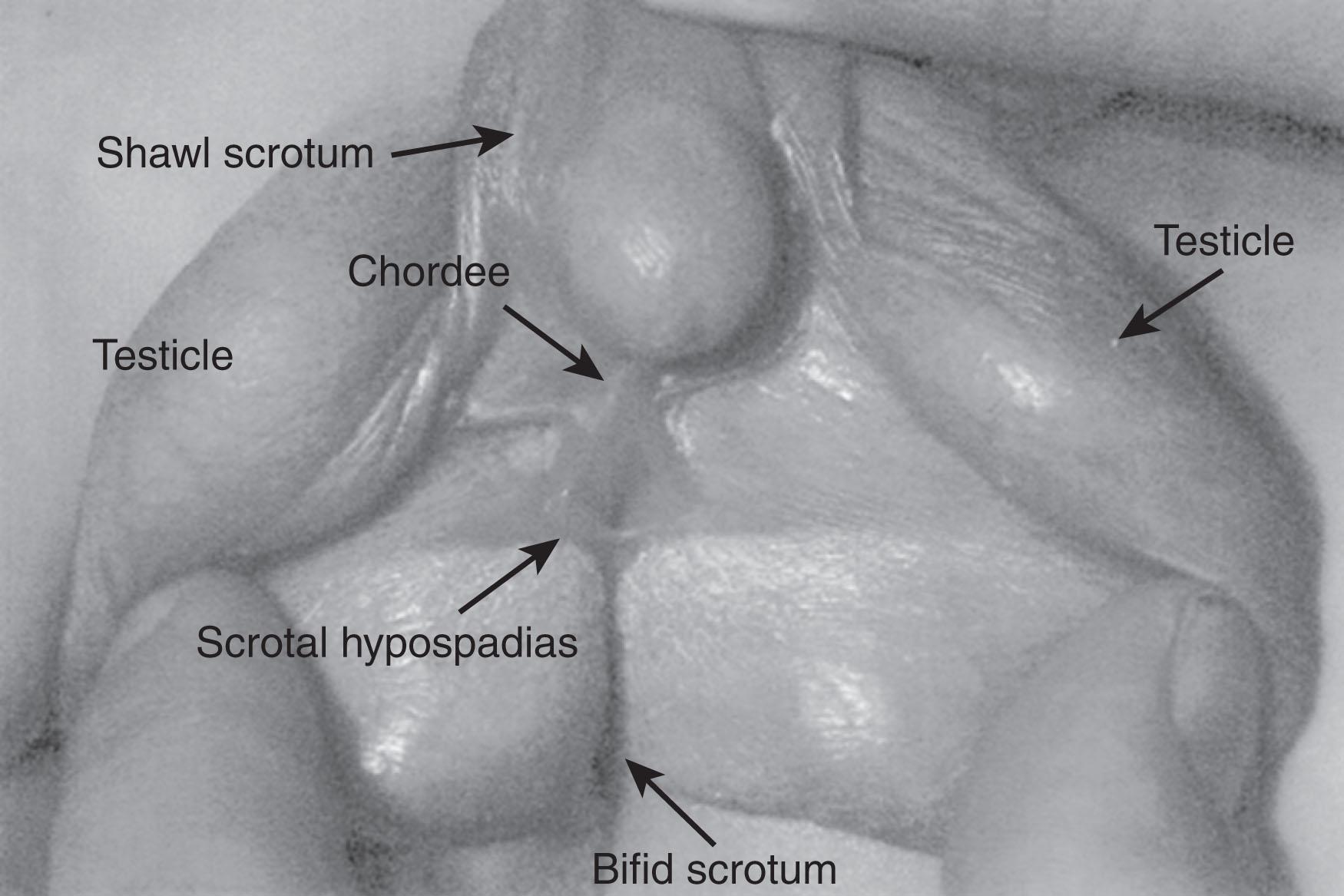 Fig. 85.5, Undervirilized male demonstrating bifid scrotum, scrotal hypospadias, chordee, and bilateral descended testes.