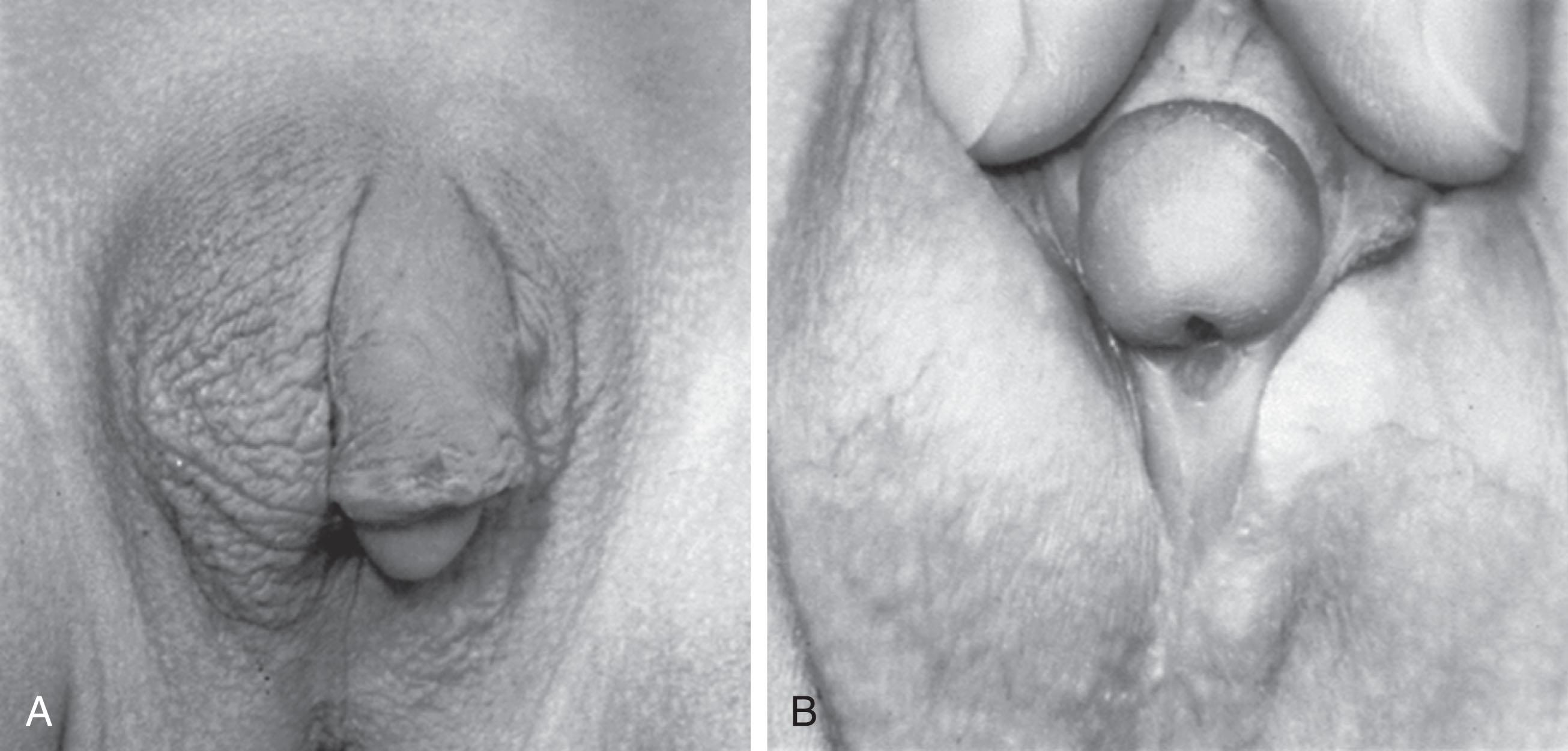 Fig. 85.7, Asymmetric external genitals with left unilateral descended testis (A), penoscrotal hypospadias, and chordee (B). Asymmetric external genital development or gonadal descent would be characteristic of mixed gonadal dysgenesis or ovotesticular disorder of sexual development.