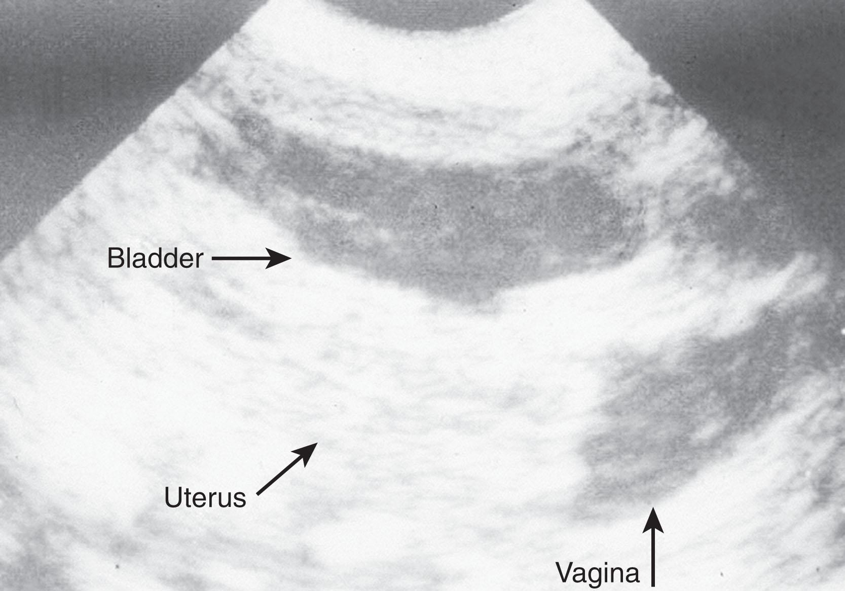 Fig. 85.9, Ultrasound image from a 46,XX infant with ambiguous genitalia. Note the presence of a well-developed uterus with an endometrial stripe.