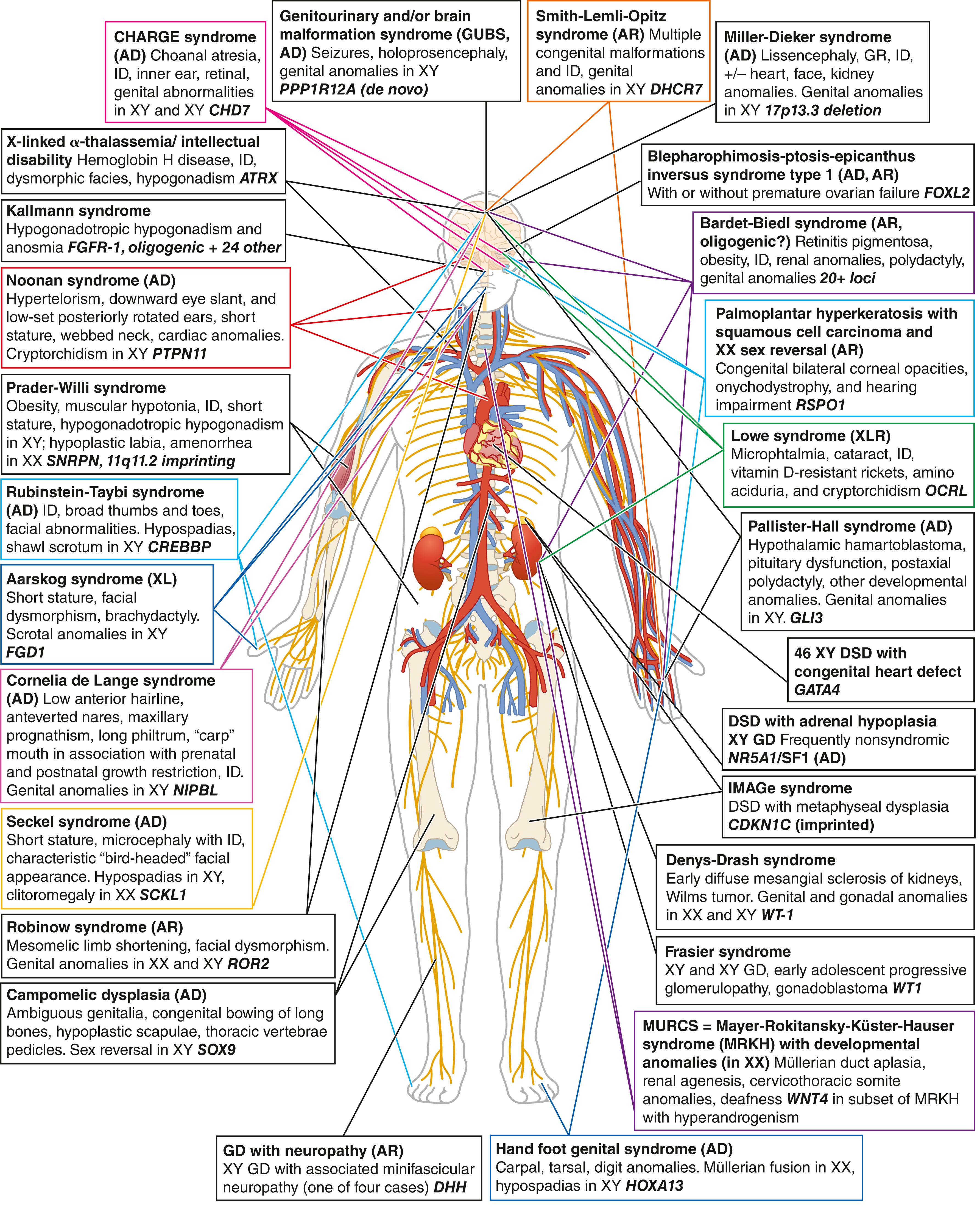 Fig. 17.5, Illustration of the many extragenital manifestations associated with DSD in syndromic form.