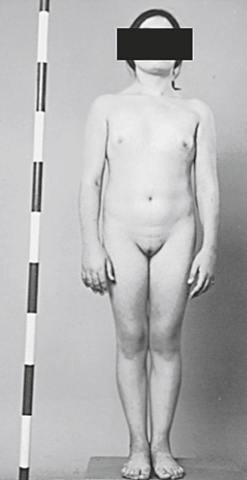 Fig. 17.6, Patient with Turner syndrome.