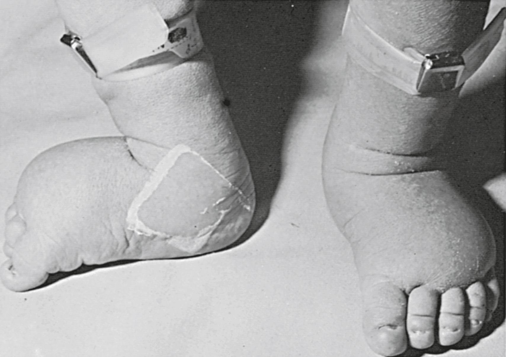 Fig. 17.7, Lymphedema in the lower extremities of an infant with Turner syndrome.