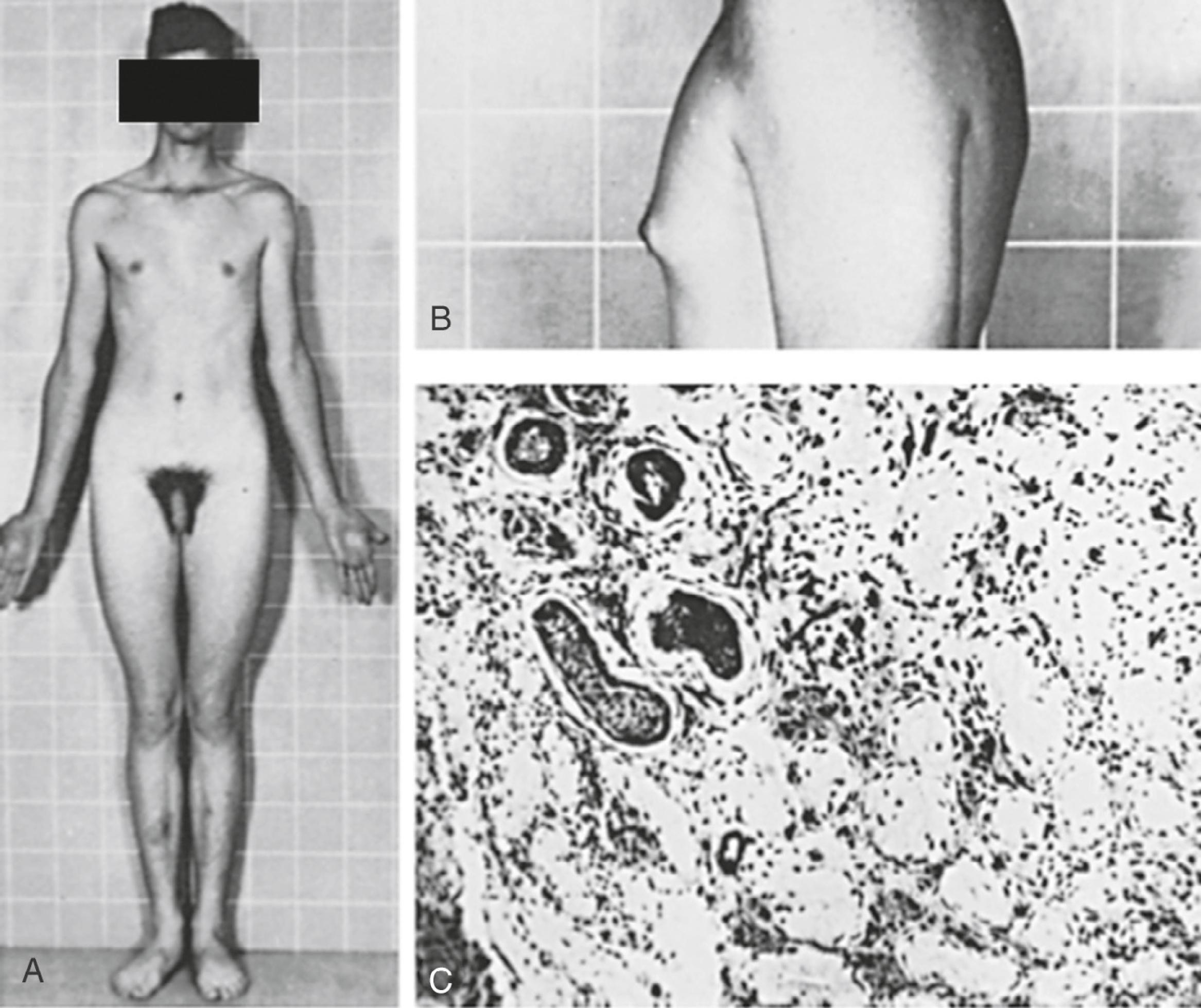 Fig. 17.8, Klinefelter syndrome.