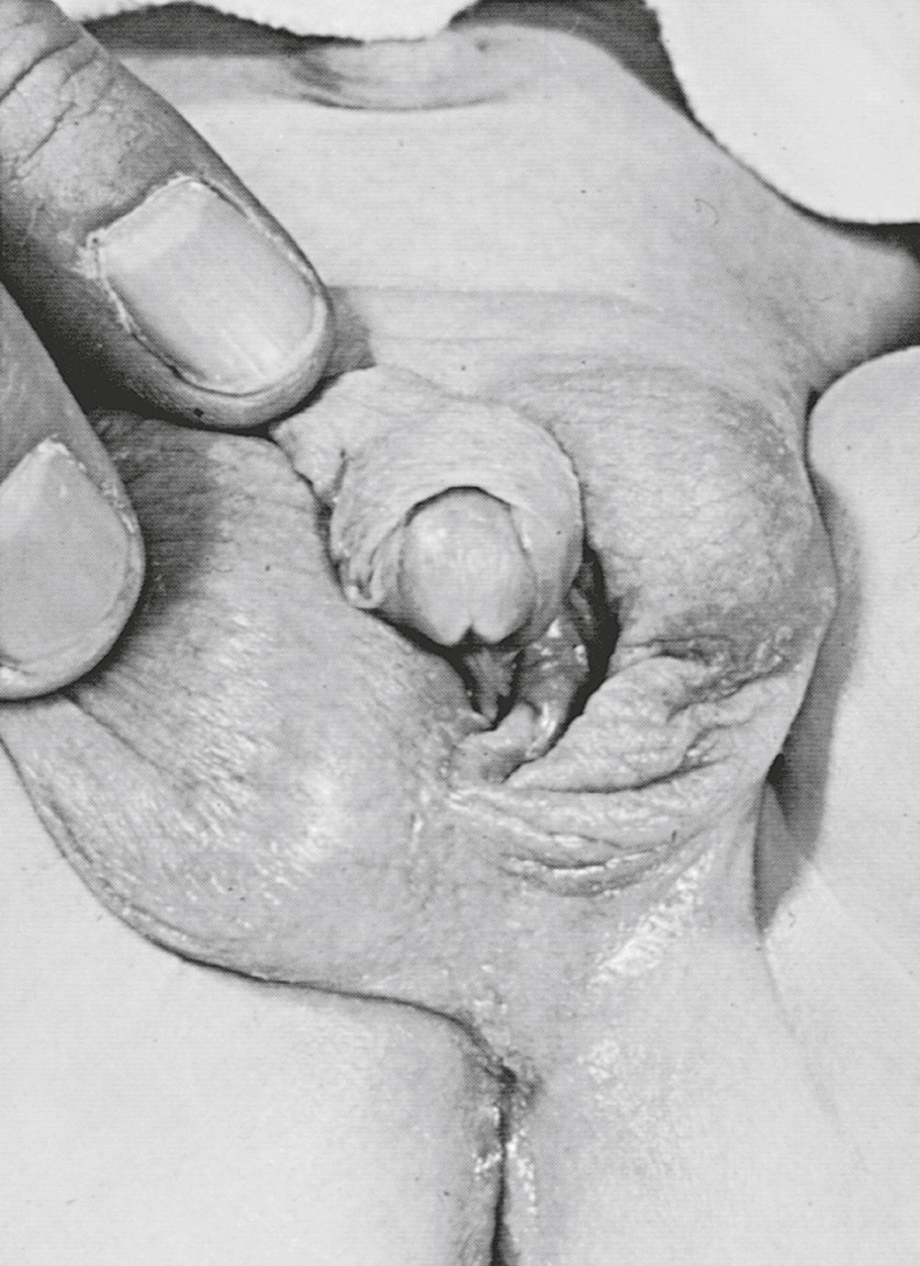 Fig. 17.9, External genitalia of infant with 45,X/46,XY mosaicism.