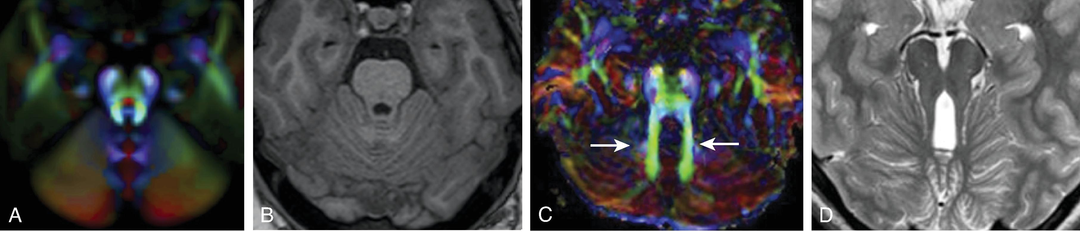 Joubert Syndrome (JS).