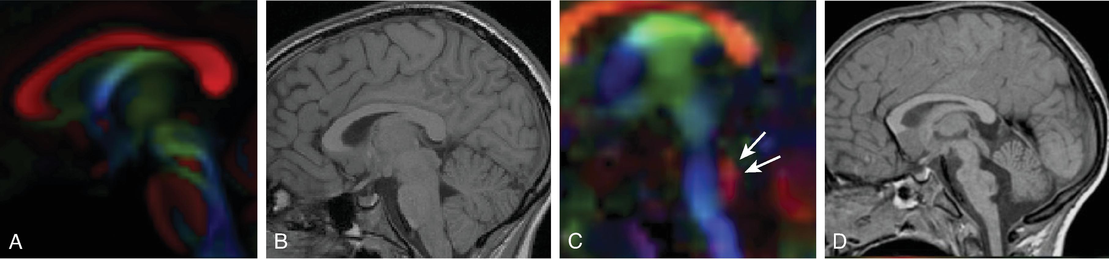 Pontine Tegmental Cap Dysplasia (PTCD).