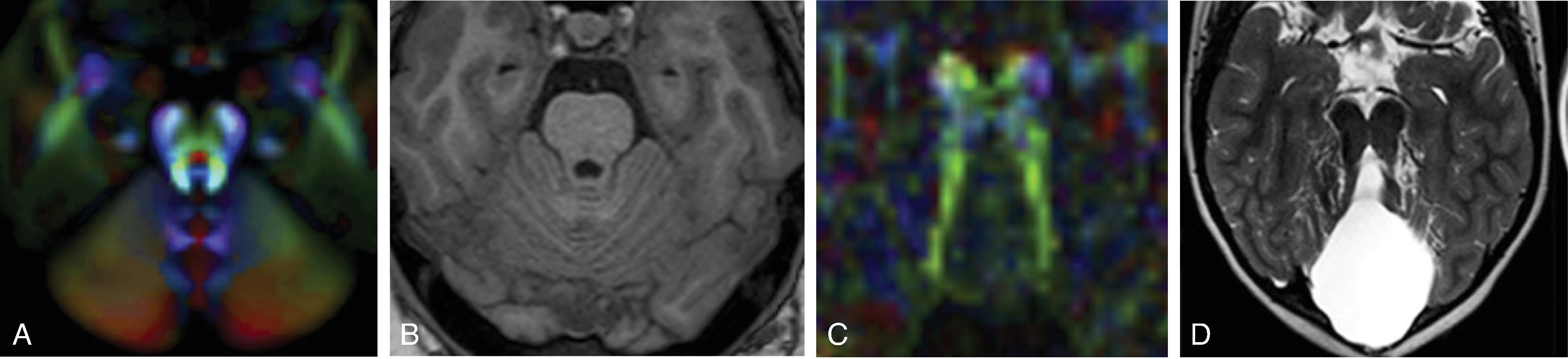 Tectocerebellar Dysraphism and Occipital Encephalocele (TCD-OE).