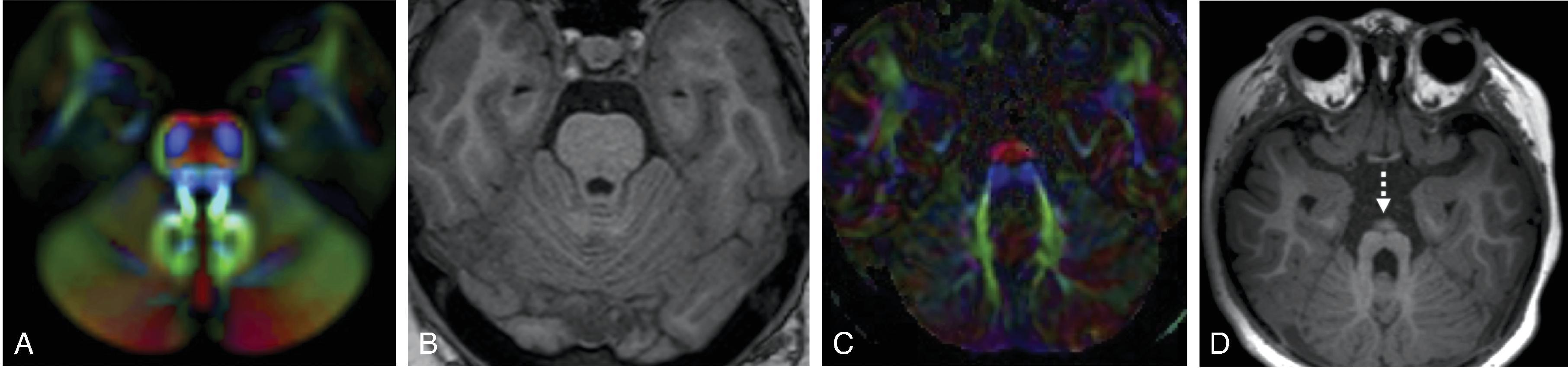 Anterior Mesencephalic Cap Dysplasia.