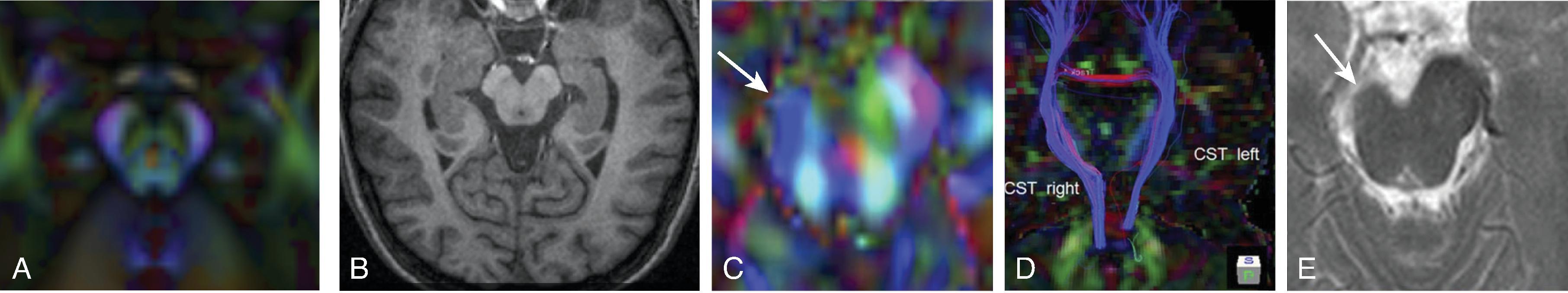 Aberrant Corticospinal tract (CST).