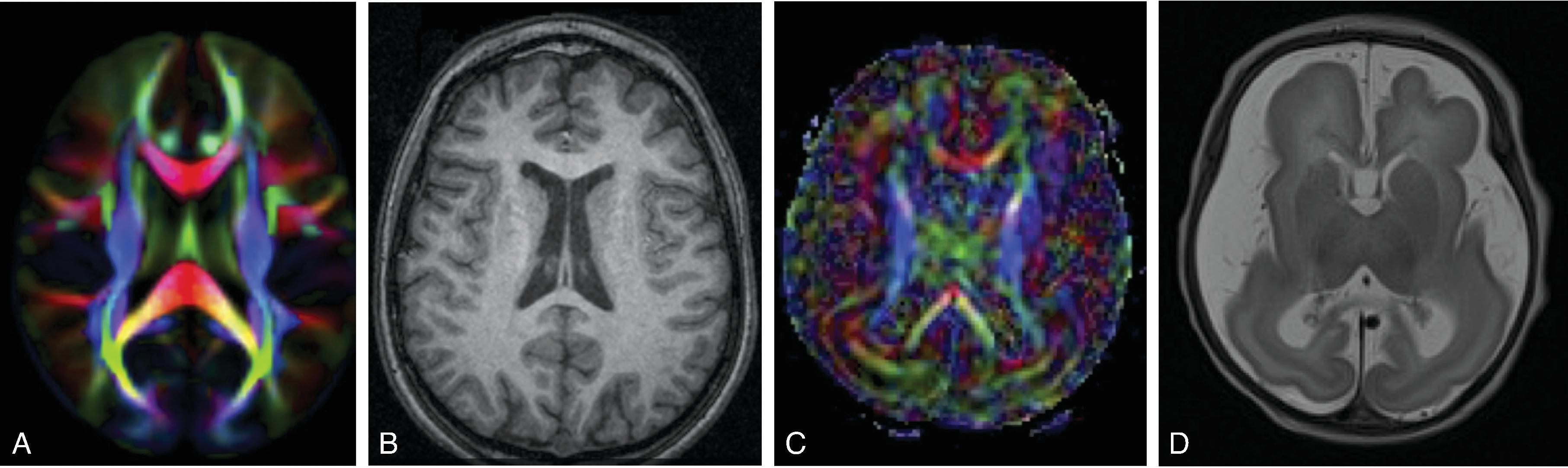 Lissencephaly.