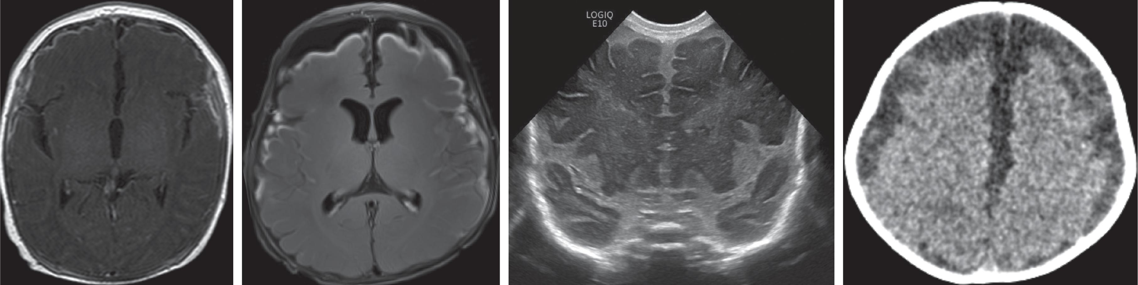 Leptomeningitis