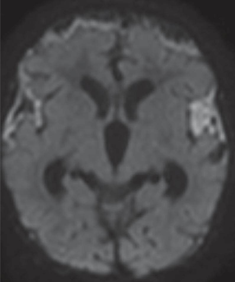 Empyema/Purulent Extra-Axial Material