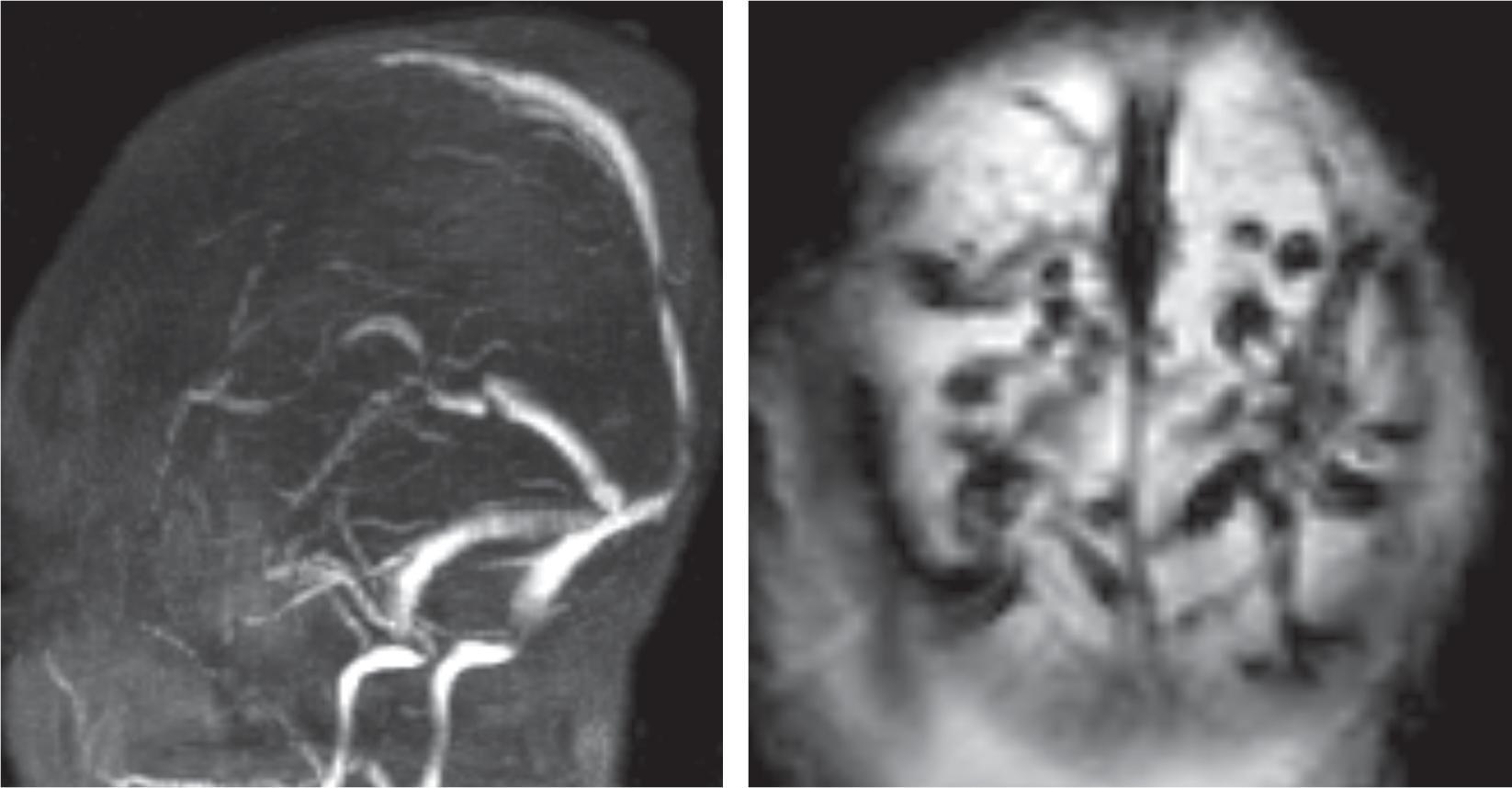 Venous Thrombosis