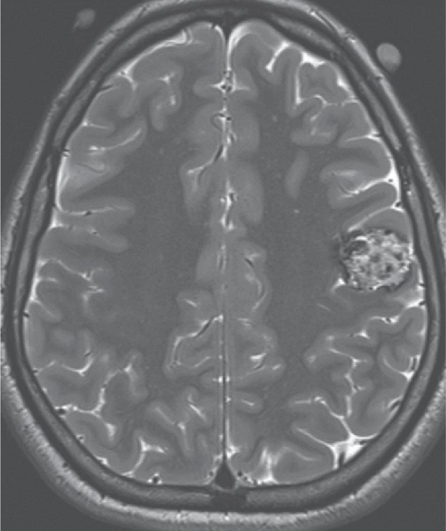 Cavernoma