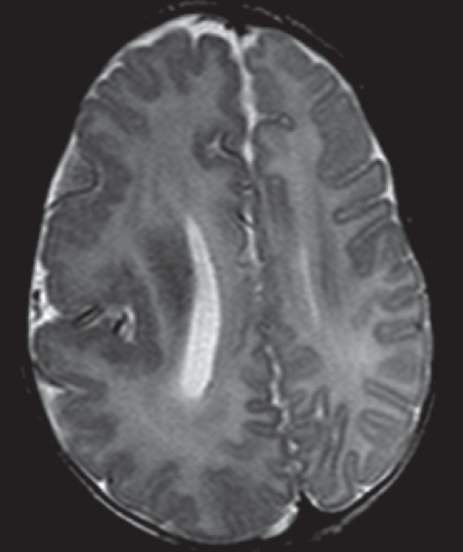 Cortical Malformation