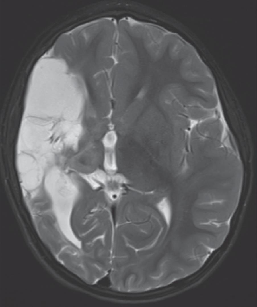 Encephalomalacia