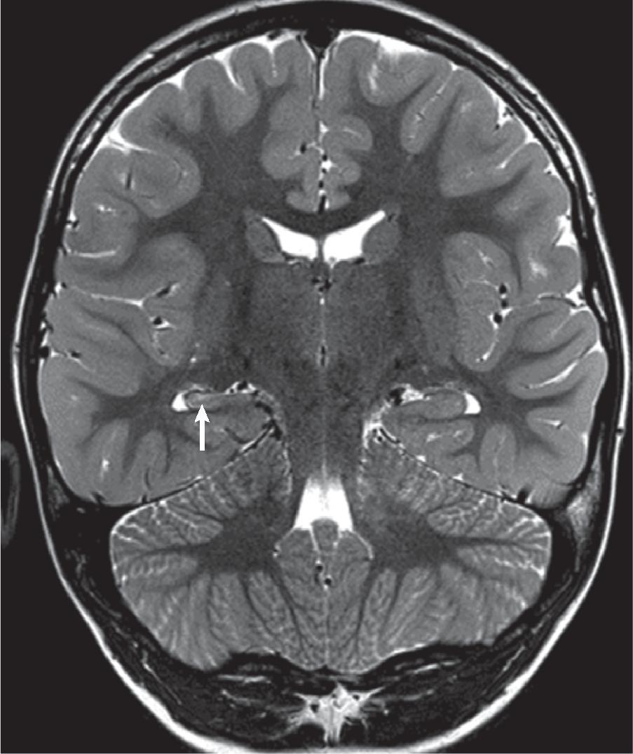 Mesial Temporal Sclerosis