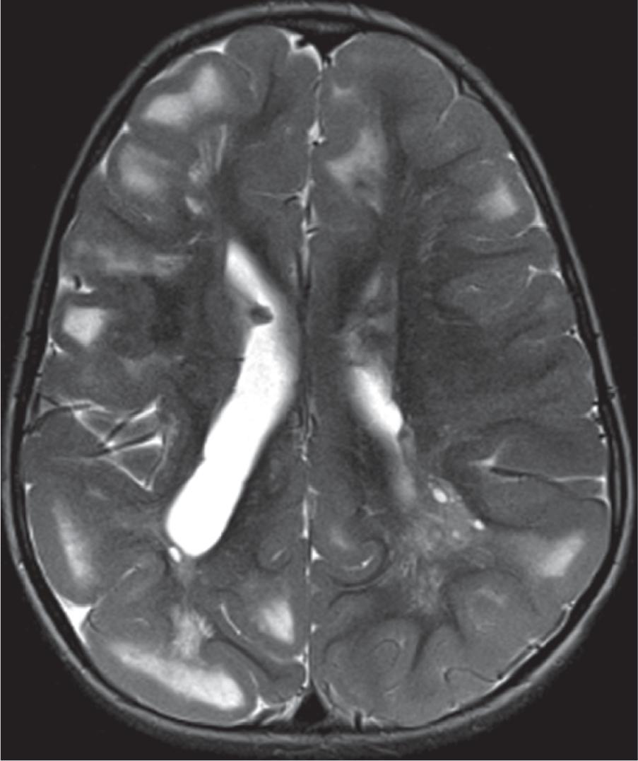 Tuberous Sclerosis